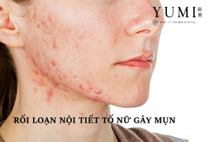 Điều trị mụn nội tiết