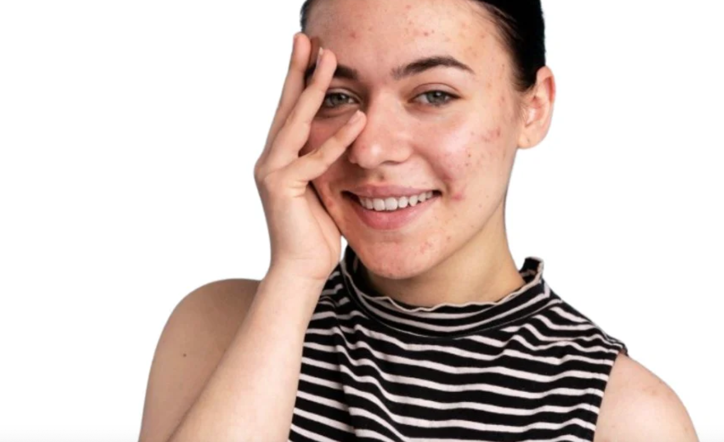 Valie beauty trị mụn hiệu quả